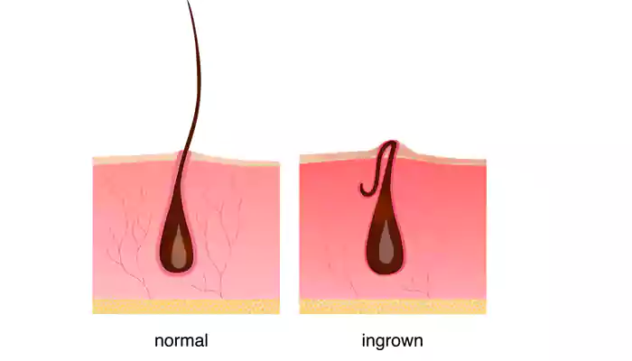 Loading: Smooth Skin – Ingrown Hair Symptoms, Causes and Prevention