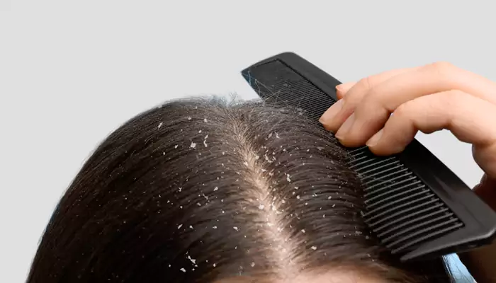 Flake Facts – Understanding the Difference Between Dandruff and Dry Scalp