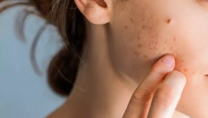 You’re Never Too Old For Adult Acne - But Don’t Lose Hope!