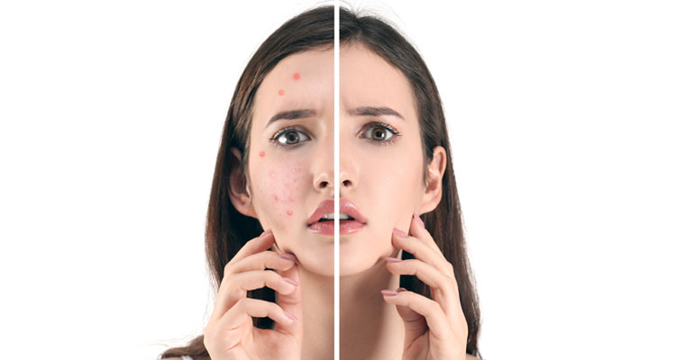 5 Simple Home remedies to get rid of acne
