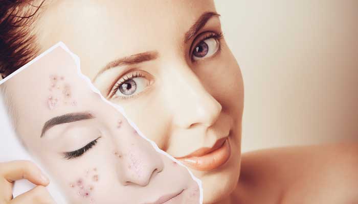 10 Common Acne Skincare Mistakes That Make It Worse: Sensitive Skincare Myths