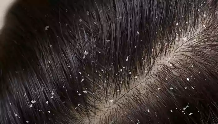 What Causes Dandruff, And How To Treat It