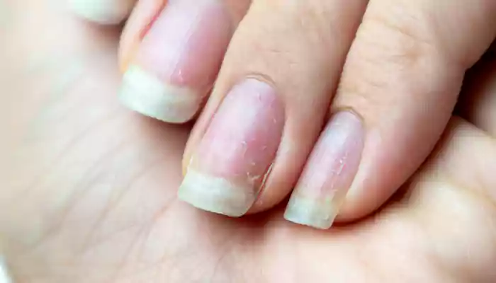 What Makes The Skin Around Your Nails Dry? How To Hydrate It